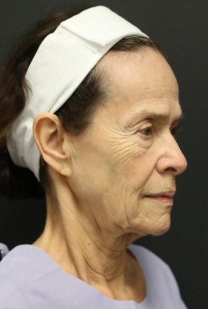 Facelift Before & After Patient #1186