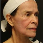 Facelift Before & After Patient #1186