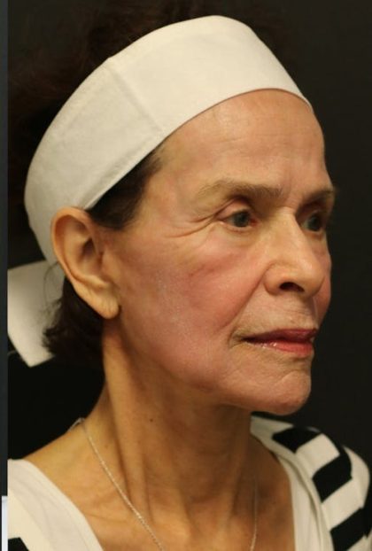 Facelift Before & After Patient #1186