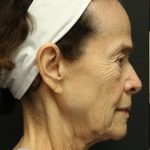 Facelift Before & After Patient #1186