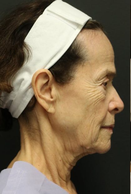 Facelift Before & After Patient #1186