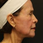 Facelift Before & After Patient #1186