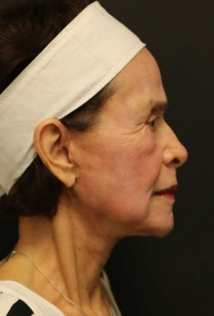 Facelift Before & After Patient #1186