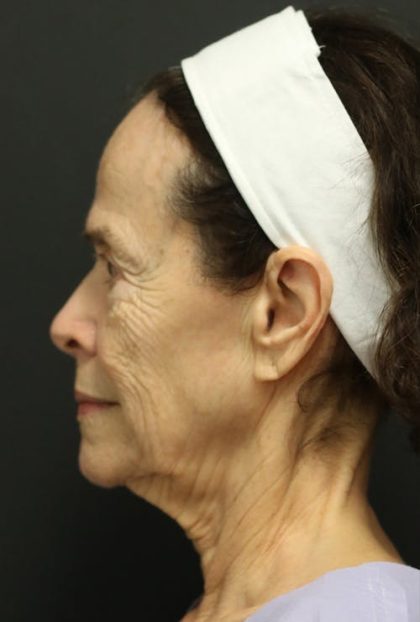 Facelift Before & After Patient #1186