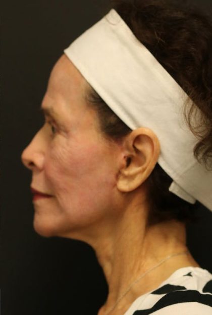 Facelift Before & After Patient #1186