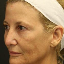 Facelift Before & After Patient #1184
