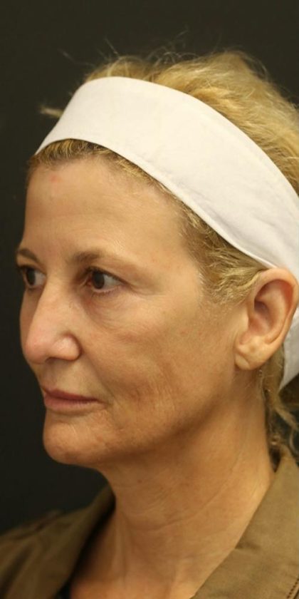 Facelift Before & After Patient #1184
