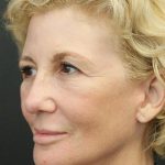 Facelift Before & After Patient #1184