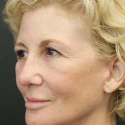 Facelift Before & After Patient #1184