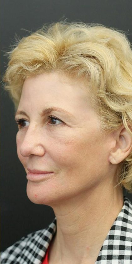 Facelift Before & After Patient #1184