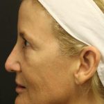 Facelift Before & After Patient #1184