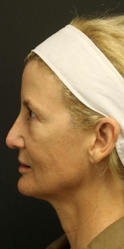 Facelift Before & After Patient #1184