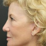 Facelift Before & After Patient #1184