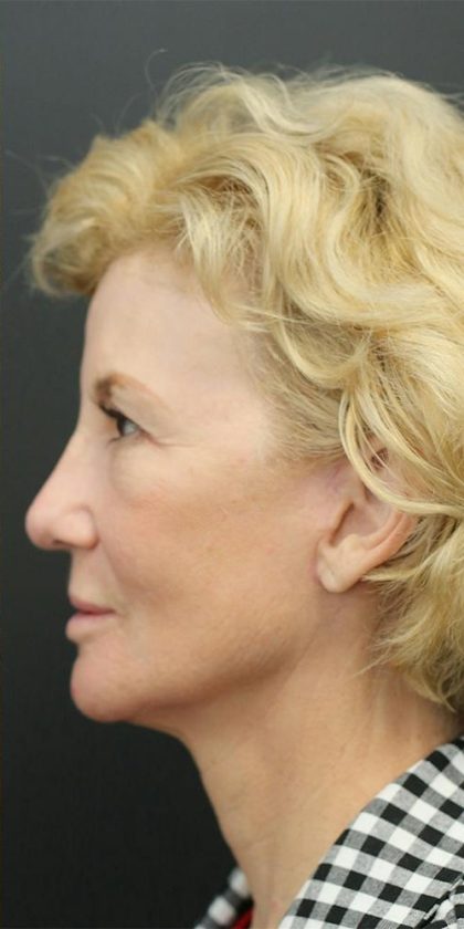 Facelift Before & After Patient #1184