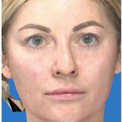Facelift Before & After Patient #1183