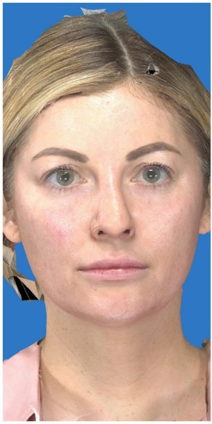 Facelift Before & After Patient #1183