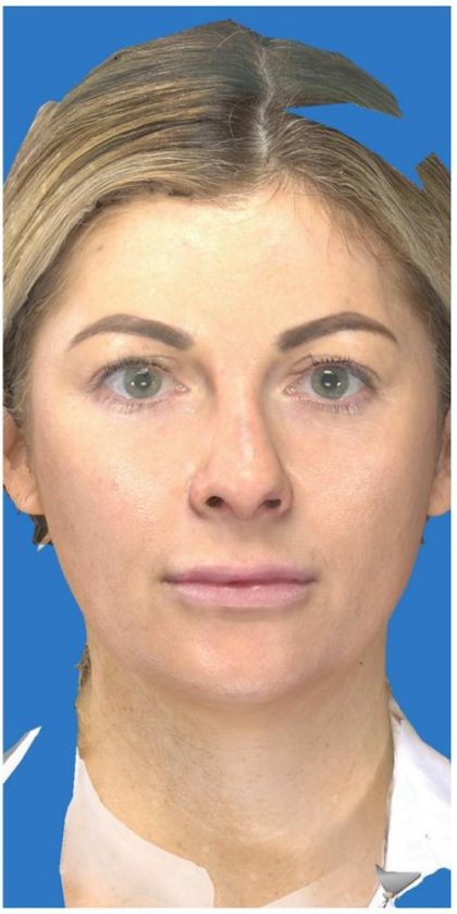 Facelift Before & After Patient #1183