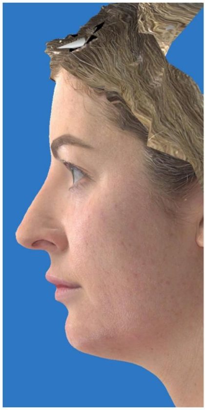 Facelift Before & After Patient #1183