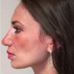 Fat Grafting Before & After Patient #1190
