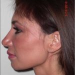 Fat Grafting Before & After Patient #1190