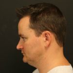 Fat Grafting Before & After Patient #1189