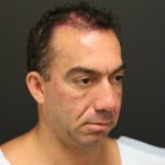 Fat Grafting Before & After Patient #1188