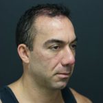 Fat Grafting Before & After Patient #1188