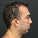 Fat Grafting Before & After Patient #1188
