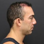 Fat Grafting Before & After Patient #1188