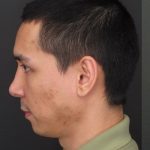 Fat Grafting Before & After Patient #1187