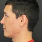 Fat Grafting Before & After Patient #1187
