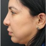 Jawline Filler Before & After Patient #1325