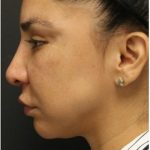Jawline Filler Before & After Patient #1325