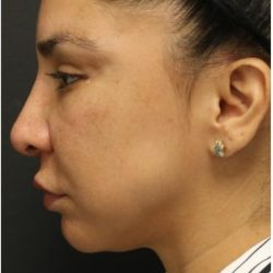 Jawline Filler Before & After Patient #1325