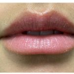 Lip Augmentation Before & After Patient #1203