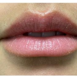 Lip Augmentation Before & After Patient #1203