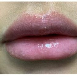 Lip Augmentation Before & After Patient #1203
