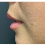 Lip Augmentation Before & After Patient #1203