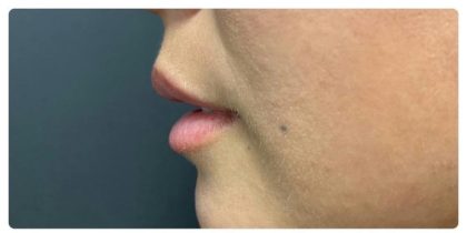 Lip Augmentation Before & After Patient #1203