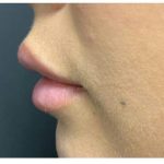 Lip Augmentation Before & After Patient #1203
