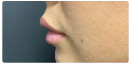 Lip Augmentation Before & After Patient #1203
