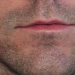 Lip Augmentation Before & After Patient #1200