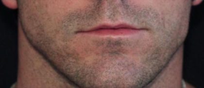Lip Augmentation Before & After Patient #1200