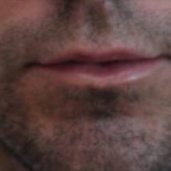 Lip Augmentation Before & After Patient #1200