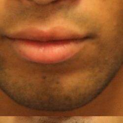 Lip Augmentation Before & After Patient #1197