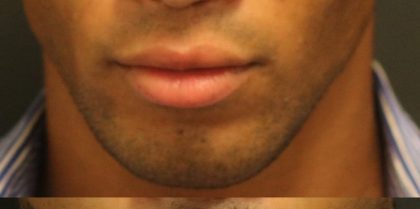 Lip Augmentation Before & After Patient #1197
