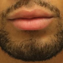 Lip Augmentation Before & After Patient #1197