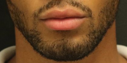 Lip Augmentation Before & After Patient #1197