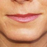Lip Augmentation Before & After Patient #1194