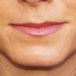 Lip Augmentation Before & After Patient #1194